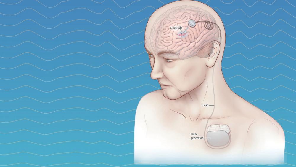 dbs electrodes