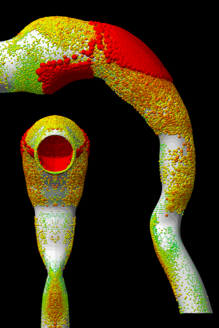 A computer model of a mouth and throat shows where aerosol medications of various sizes get stuck in the throat. When aerosol medication is administered, 60 to 90 percent is stopped in the throat before it can reach the lungs.