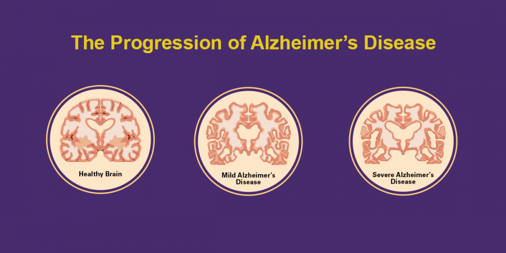 Disease Progression