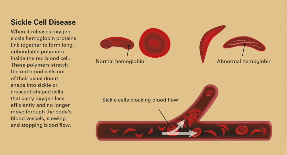 Sickle Cell Explainer